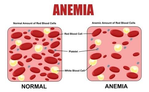 Anemia Check at OM Clinical Lab